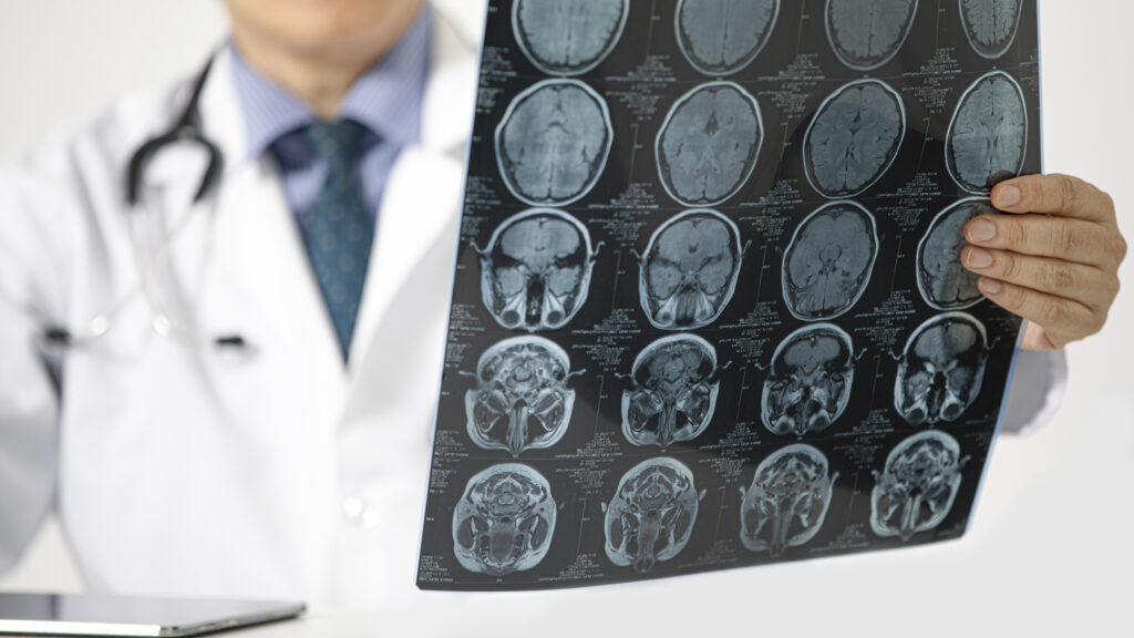 brain scan after head injury